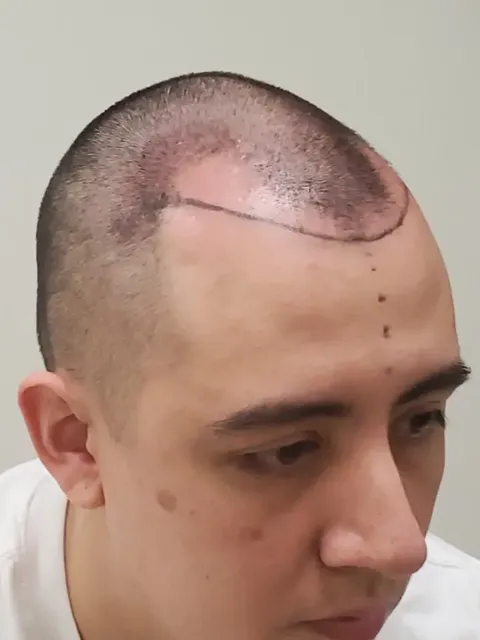 HairDot SMP comparison 24, before