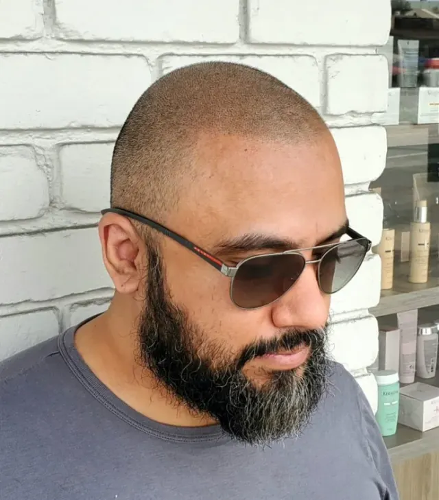 HairDot scalp micropigmentation example from the photo gallery
