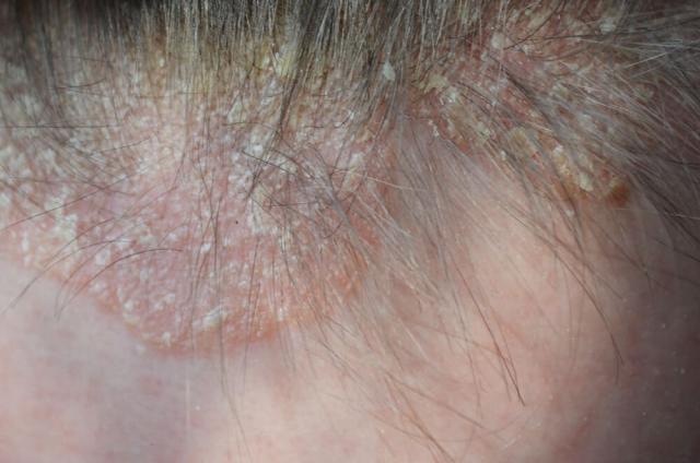 Connection Between Dry Scalp and Hair Loss- Psoriasis