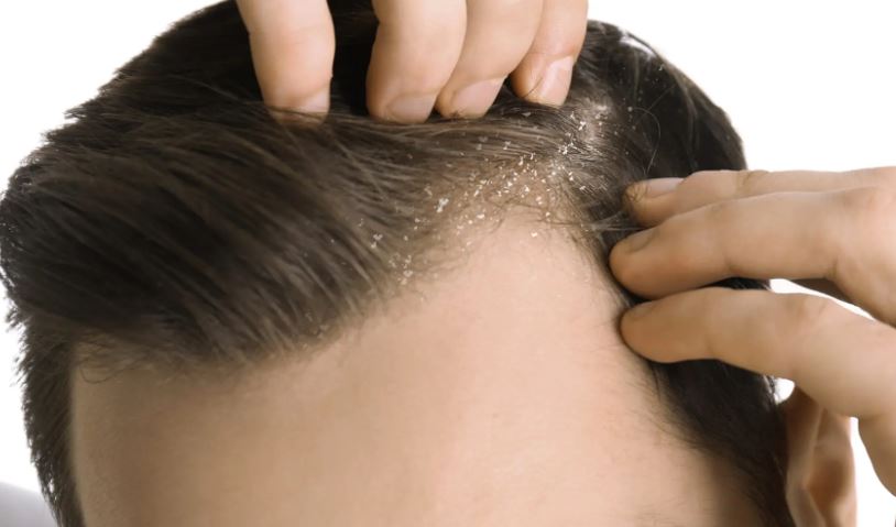 Connection Between Dry Scalp and Hair Loss