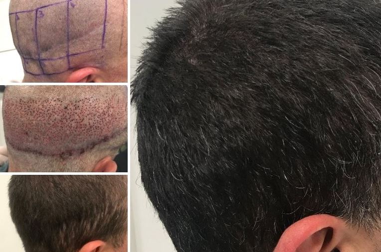 Hair Transplant for Hiding a Head Scar