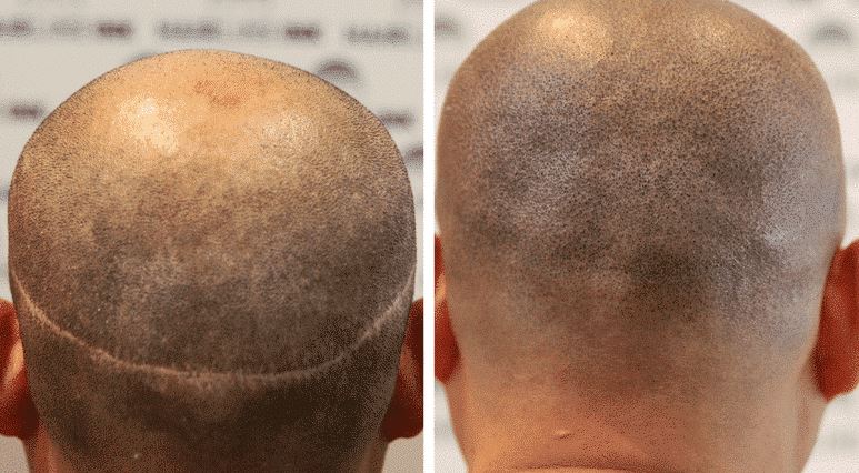 scalp micropigmentation hiding head scar