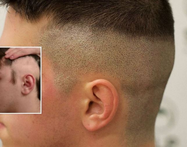 shaved look for scalp micropigmentation Hair thinning only on the sides
