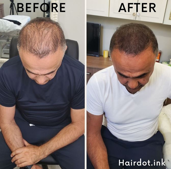 shaved look for scalp micropigmentation Some hair thinning on the top with Fairly defined hairline