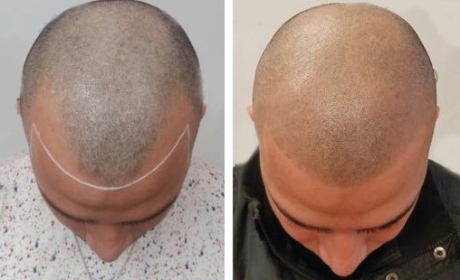 Scalp Micropigmentation Before and After image